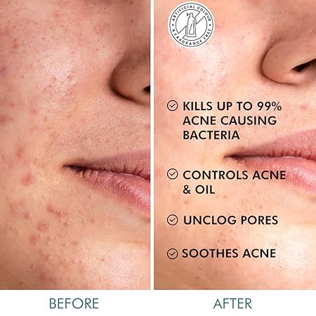 MCAFFEINE ACNE PADS CLEAR SKIN 2% SALICYLIC ACID ZINE PCA & MATCHA TEA