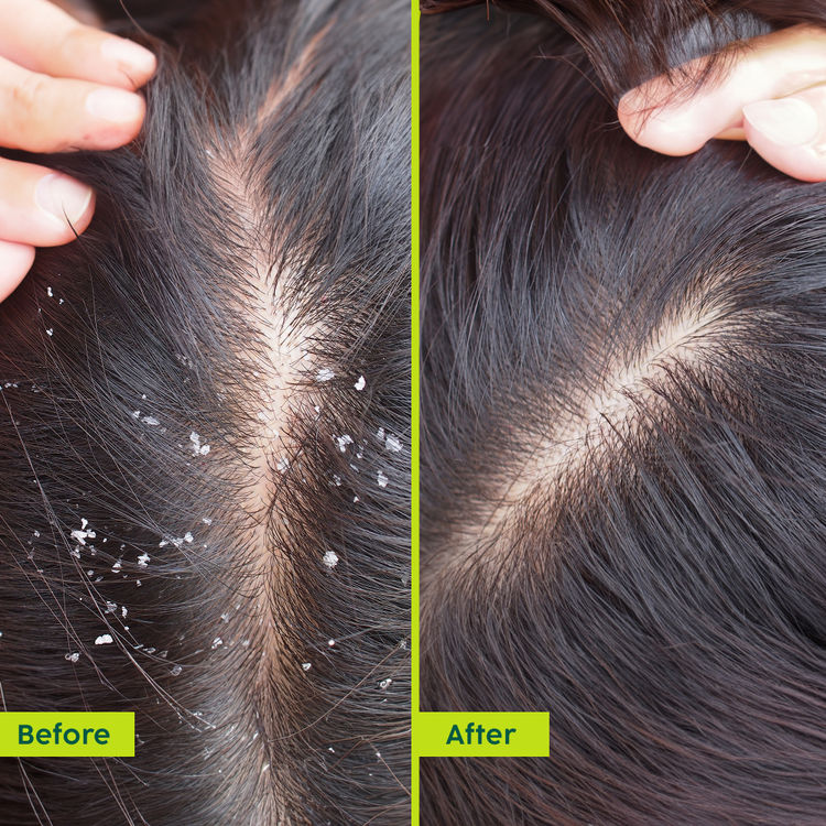 PLIX NEEM ANTI-DANDRUFF ADVANCED HAIR SERUM 50ML
