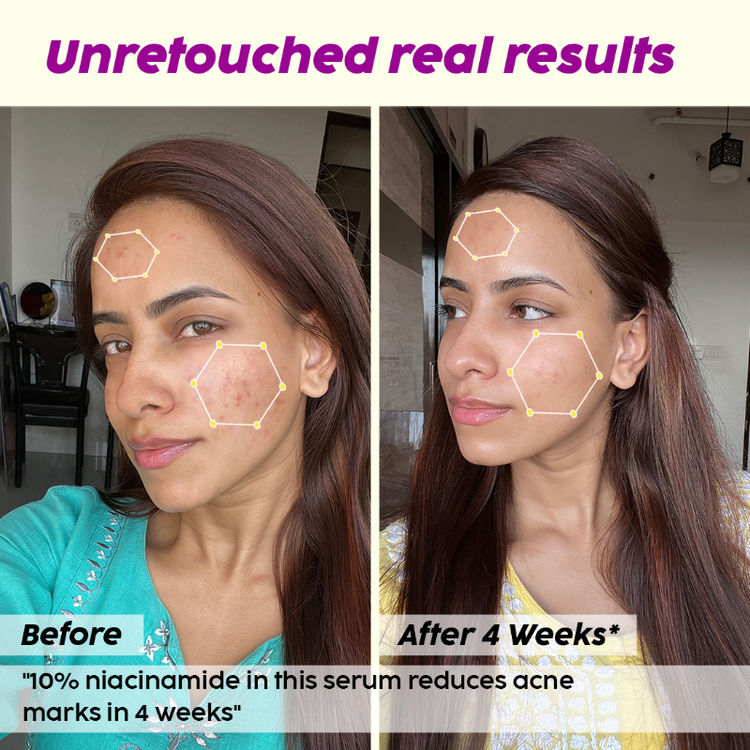 PLIX JAMUN ACNE MARKS REGIME COMBO