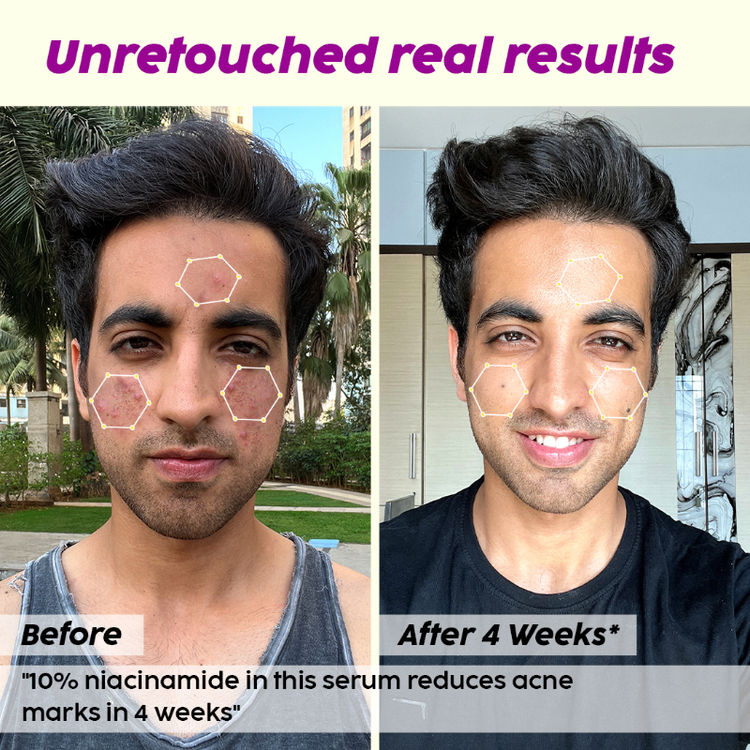 PLIX JAMUN ACNE MARKS REGIME COMBO