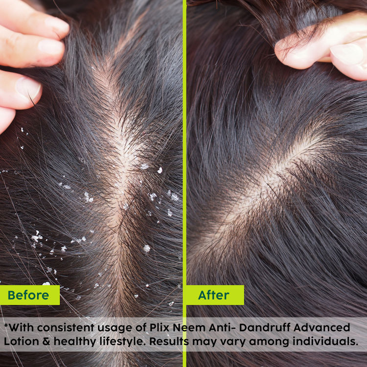 PLIX NEEM ANTI-DANDRUFF ADVANCED LOTION 60ML